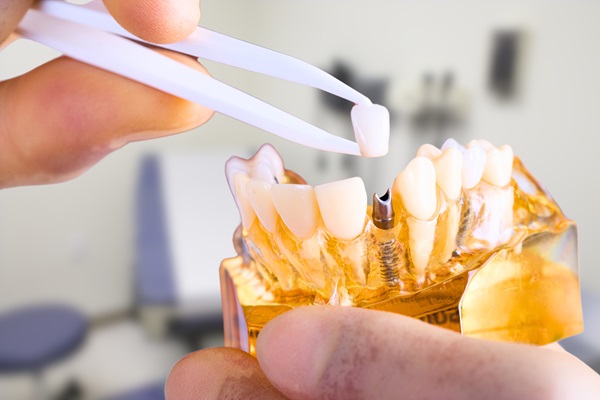 Dental Implant To Replace Single Missing Tooth